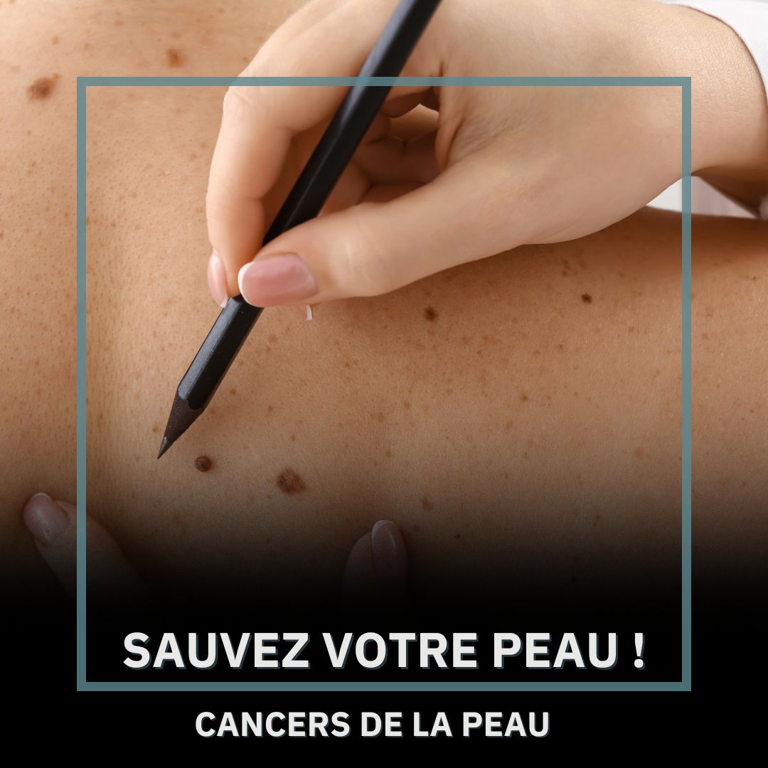 SAUVEZ VOTRE PEAU !