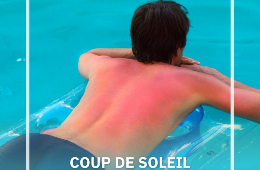 QUE FAIRE EN CAS DE COUP DE SOLEIL ?