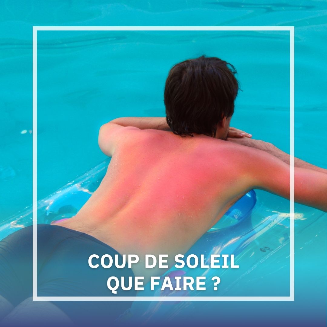 QUE FAIRE EN CAS DE COUP DE SOLEIL ?