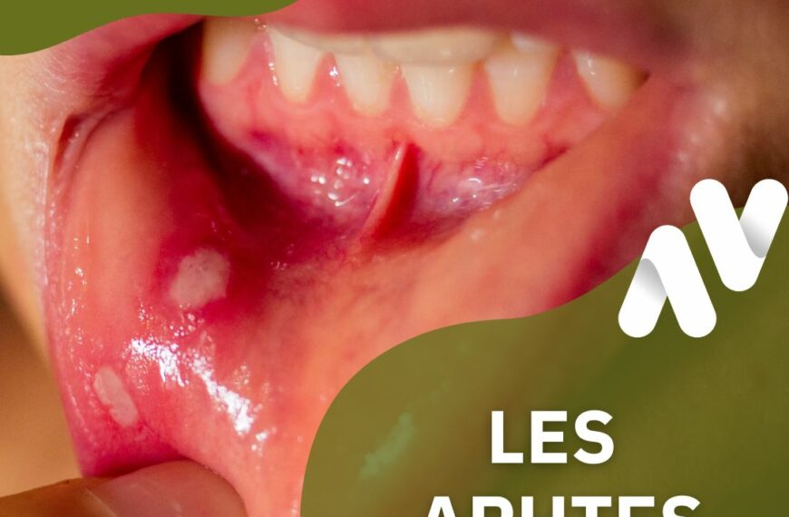 Focus sur… Mes dents : Les aphtes