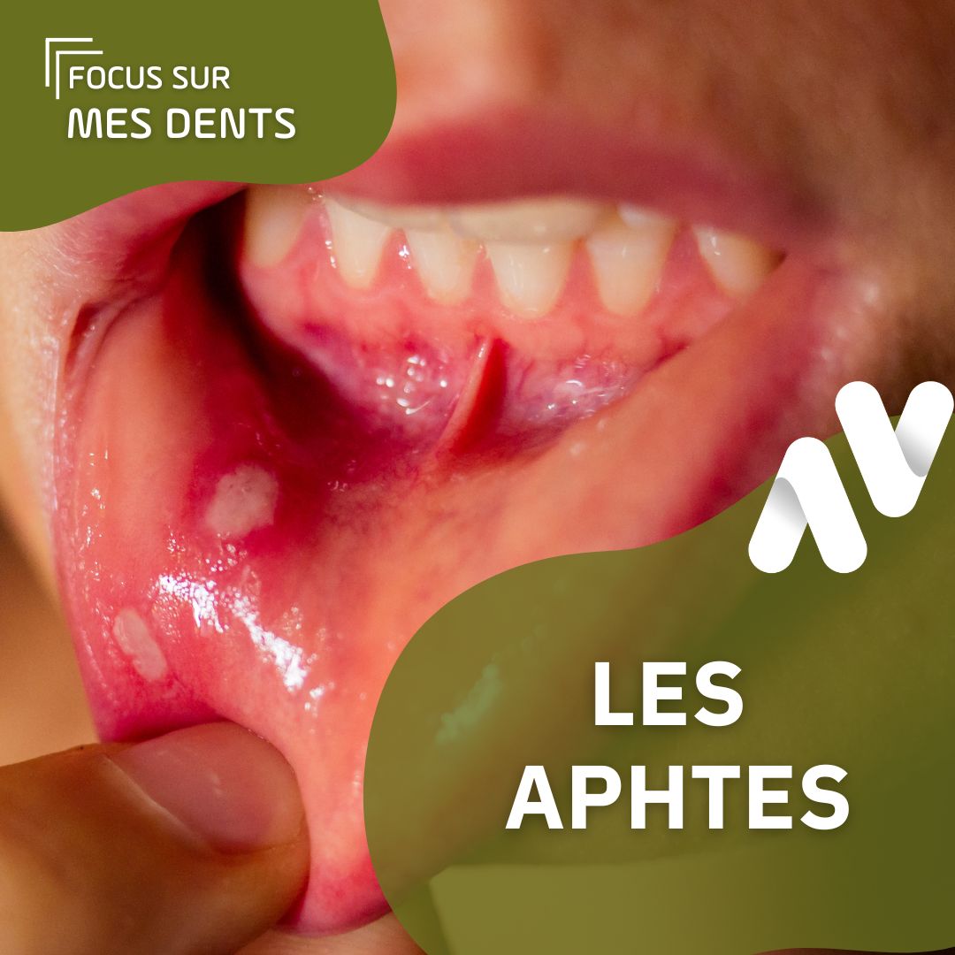 Focus sur… Mes dents : Les aphtes